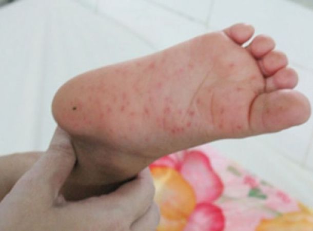 Νόσος χεριών-ποδιών-στόματος από ιό κοξάκι