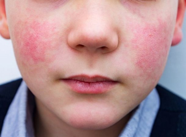 Λοίμωξη από παρβοϊό Β19