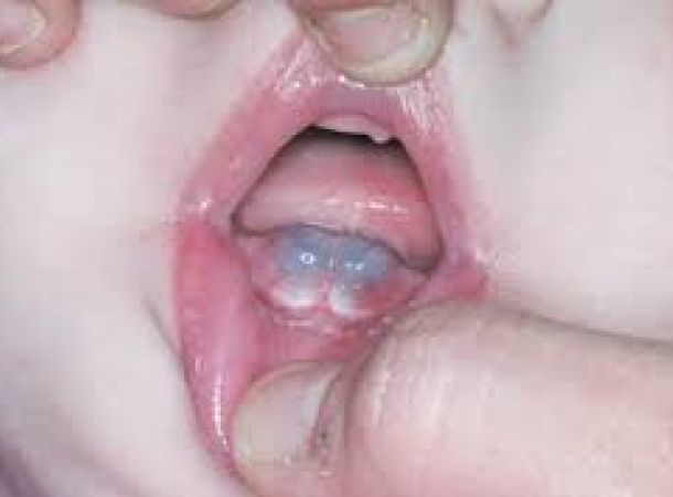 Κύστη ανατολής