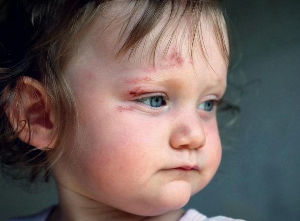 Κακώσεις Κεφαλής σε παιδιά