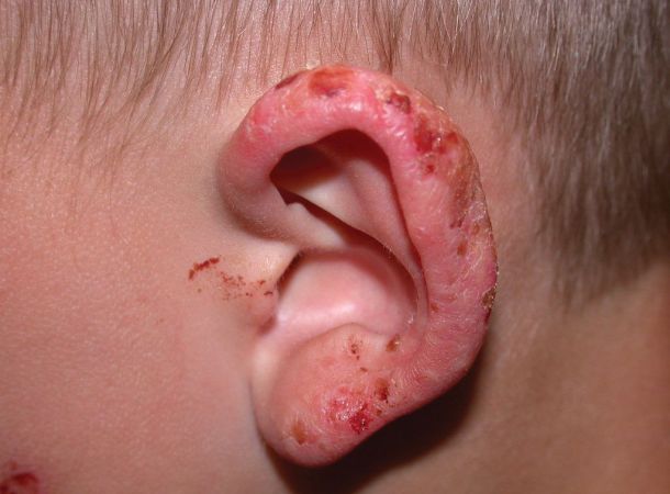 Νεανικό εαρινό εξάνθημα των ώτων