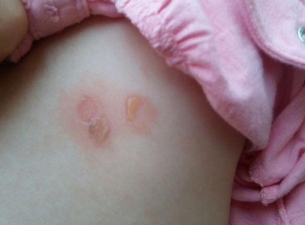 Σταφυλόκοκκος