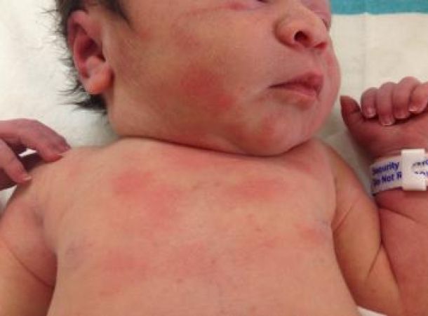 Συνηθισμένα νεογνικά σημάδια και εξανθήματα