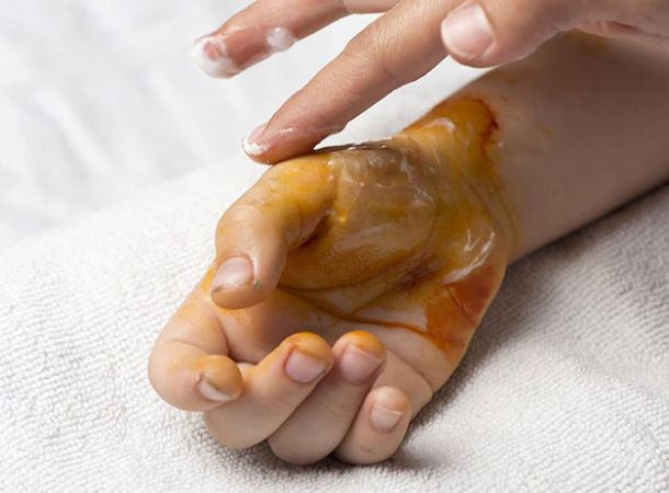 Ηλιακό έγκαυμα